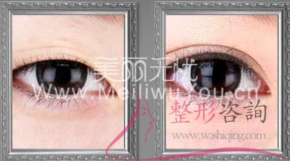 割<a href=http://www.sbs17.com/listinfo-724-0.html target=_blank class=infotextkey>雙眼皮</a>手術(shù)