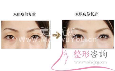 <a href=http://www.sbs17.com/listinfo-724-0.html target=_blank class=infotextkey>雙眼皮</a>修復(fù)