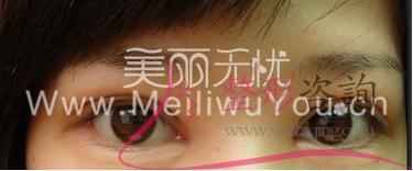 割開法<a href=http://www.sbs17.com/listinfo-724-0.html target=_blank class=infotextkey>雙眼皮</a>