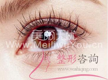 <a href=http://www.sbs17.com/listinfo-724-0.html target=_blank class=infotextkey>雙眼皮</a>手術