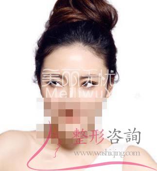 割<a href=http://www.sbs17.com/listinfo-724-0.html target=_blank class=infotextkey>雙眼皮</a>