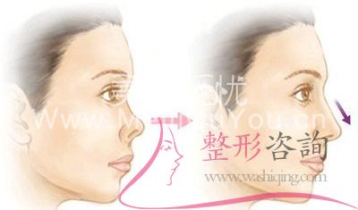 <a href=http://www.sbs17.com/listinfo-758-0.html target=_blank class=infotextkey>朝天鼻矯正</a>術(shù)