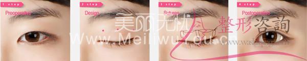 韓式三點<a href=http://www.sbs17.com/listinfo-724-0.html target=_blank class=infotextkey>雙眼皮</a>過程詳細說明圖