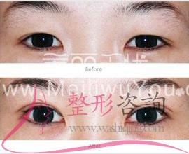 消融手術(shù)<a href=http://www.sbs17.com/listinfo-724-0.html target=_blank class=infotextkey>雙眼皮</a>