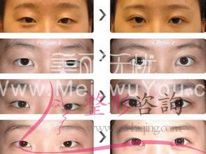 消融手術(shù)<a href=http://www.sbs17.com/listinfo-724-0.html target=_blank class=infotextkey>雙眼皮</a>