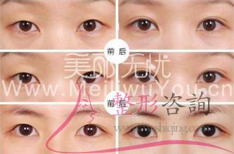 消融手術(shù)<a href=http://www.sbs17.com/listinfo-724-0.html target=_blank class=infotextkey>雙眼皮</a>