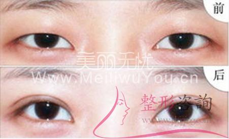 <a href=http://www.sbs17.com/listinfo-724-0.html target=_blank class=infotextkey>雙眼皮</a>