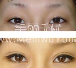 <a href=http://www.sbs17.com/listinfo-724-0.html target=_blank class=infotextkey>雙眼皮</a>商品的原理是什么?