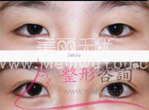 割<a href=http://www.sbs17.com/listinfo-724-0.html target=_blank class=infotextkey>雙眼皮</a>