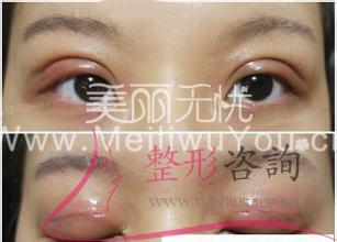 <a href=http://www.sbs17.com/listinfo-724-0.html target=_blank class=infotextkey>雙眼皮</a>手術(shù)：開<a href=http://www.sbs17.com/listinfo-724-0.html target=_blank class=infotextkey>雙眼皮</a>最好樣子