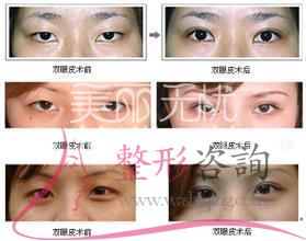 韓式<a href=http://www.sbs17.com/listinfo-724-0.html target=_blank class=infotextkey>雙眼皮</a>獨具一格優(yōu)勢 專家超超超強力強烈推薦