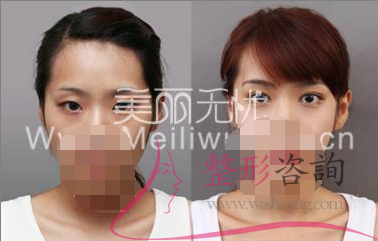 割<a href=http://www.sbs17.com/listinfo-724-0.html target=_blank class=infotextkey>雙眼皮</a>失敗 <a href=http://www.sbs17.com/listinfo-724-0.html target=_blank class=infotextkey>雙眼皮</a>修復需立刻