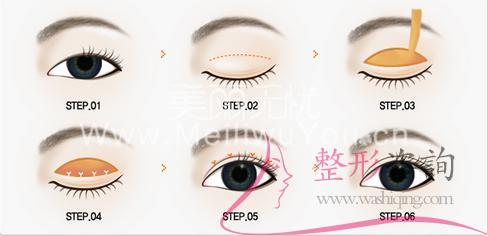 割開割<a href=http://www.sbs17.com/listinfo-724-0.html target=_blank class=infotextkey>雙眼皮</a>手術(shù)