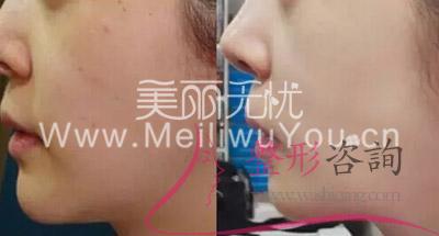 打<a href=http://www.sbs17.com/listinfo-790-0.html target=_blank class=infotextkey>水光針</a>