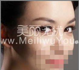 微創(chuàng)<a href=http://www.sbs17.com/listinfo-724-0.html target=_blank class=infotextkey>雙眼皮</a>手術(shù)治療治療