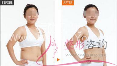 腹部<a href=http://www.sbs17.com/listinfo-685-0.html target=_blank class=infotextkey>吸脂</a>術