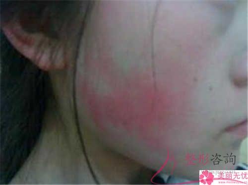 582元激光能醫(yī)治臉部紅血絲嗎？是否傷害膚質(zhì)？