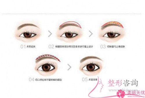 一次皮秒激光<a href=http://www.sbs17.com/listinfo-658-0.html target=_blank class=infotextkey>洗眉</a>能夠清潔凈紋眉嗎