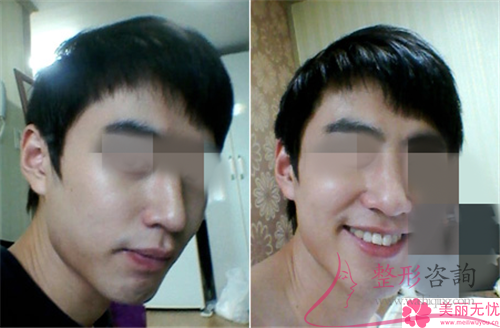 單純假體<a href=http://www.sbs17.com/listinfo-737-0.html target=_blank class=infotextkey>隆鼻</a>之后應(yīng)該如何防患病毒感染