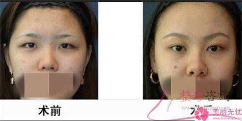受術(shù)者是否能承擔(dān)實行種眉毛的價格