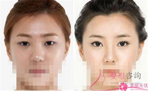 開(kāi)內(nèi)眼角后應(yīng)該怎么護(hù)理比較好？留下線頭如何是好？