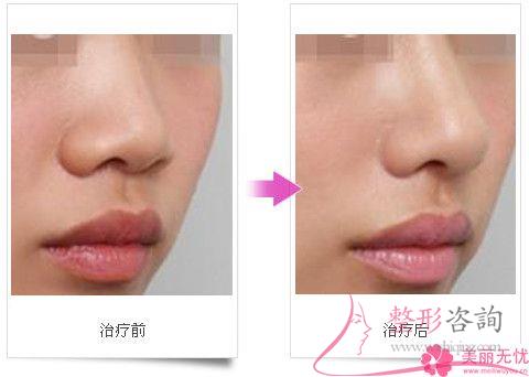 最好預(yù)備幾千塊就可實(shí)施抬高鼻梁