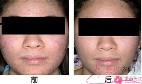 激光磨皮去痘坑能否達到無創(chuàng)修整