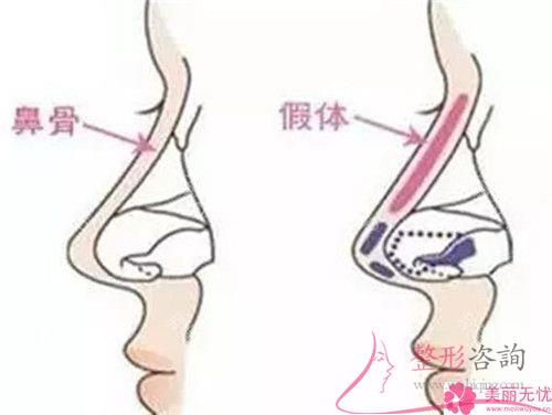 假體硅膠<a href=http://www.sbs17.com/listinfo-737-0.html target=_blank class=infotextkey>隆鼻</a>成效能維持好久？得住院嗎？