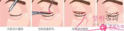 <a href=http://www.sbs17.com/listinfo-711-0.html target=_blank class=infotextkey>開眼角</a>得到的效果能夠持續(xù)25年嗎