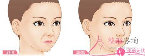 怎么樣徹底去除法令紋？指壓方法能<a href=http://www.sbs17.com/listinfo-780-0.html target=_blank class=infotextkey>去魚(yú)尾紋</a>嗎？