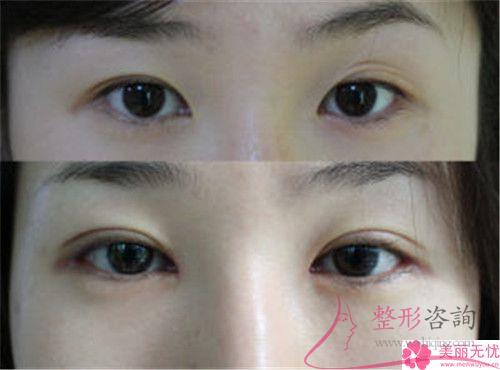 激光<a href=http://www.sbs17.com/listinfo-658-0.html target=_blank class=infotextkey>洗眉</a>毛術(shù)前術(shù)后對(duì)比效果怎樣？3307元能做嗎