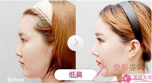 <a href=http://www.sbs17.com/listinfo-738-0.html target=_blank class=infotextkey>鼻綜合</a>怎樣恢復(fù)的快