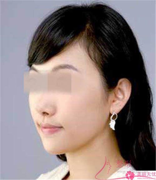 突嘴矯正多久能恢復(fù)