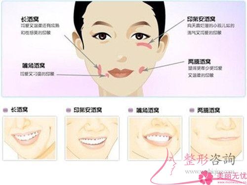 想要笑起來(lái)有酒窩，哪些手術(shù)方法可以形成酒窩