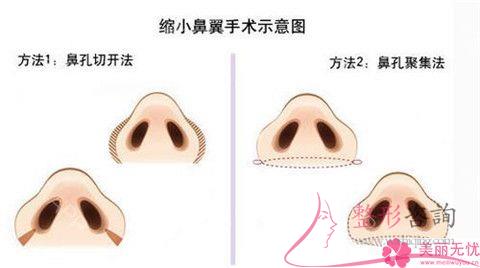 不美觀的<a href=http://www.sbs17.com/listinfo-754-0.html target=_blank class=infotextkey>鼻翼</a>應該怎么辦