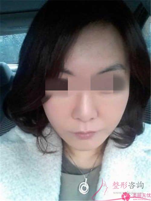 具體哪種填充<a href=http://www.sbs17.com/listinfo-614-0.html target=_blank class=infotextkey>除皺</a>措施適用于32歲的小伙伴們