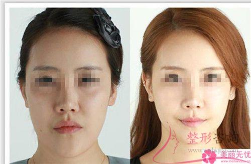 削骨<a href=http://www.sbs17.com/listinfo-631-0.html target=_blank class=infotextkey>瘦臉</a>術(shù)得注意什么