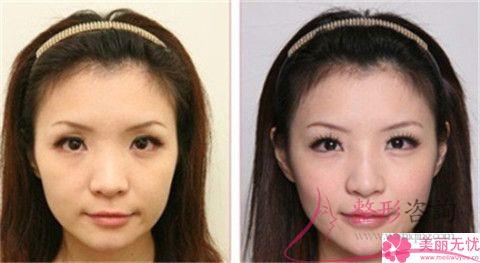 實施復合彩光<a href=http://www.sbs17.com/listinfo-770-0.html target=_blank class=infotextkey>嫩膚</a>終止會怎么樣？會復發(fā)嗎？