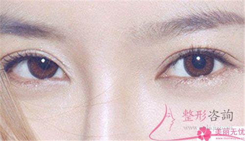 成都實(shí)施無(wú)痕<a href=http://www.sbs17.com/listinfo-711-0.html target=_blank class=infotextkey>開(kāi)眼角</a>術(shù)花多少錢？貴么