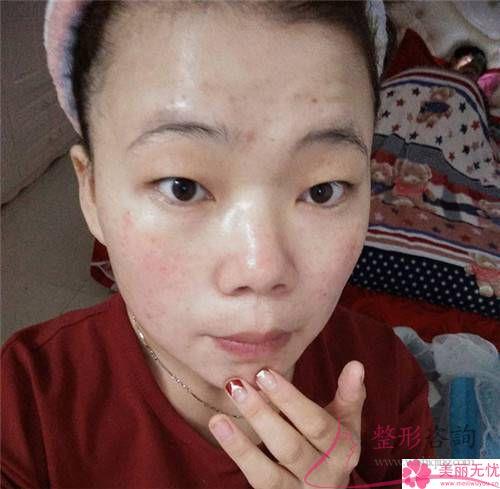 激光磨皮除痘痘有什么優(yōu)勢？瘢痕體質(zhì)可以實行嗎