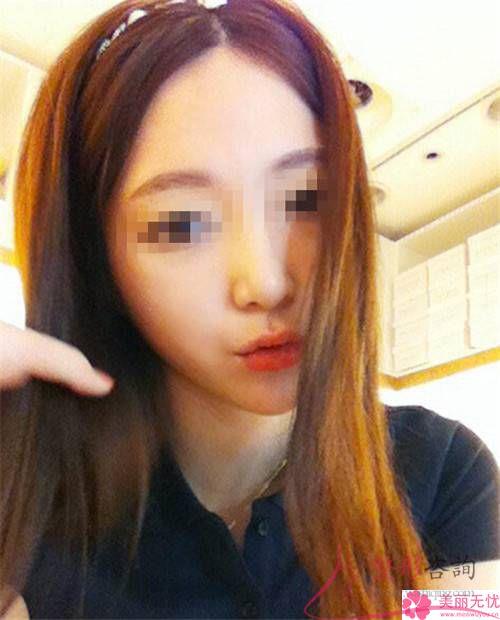 磨骨<a href=http://www.sbs17.com/listinfo-631-0.html target=_blank class=infotextkey>瘦臉</a>改臉型幾乎要好長時(shí)間還原，該怎么調(diào)理