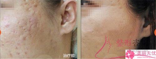 紅光與藍(lán)光祛痘存在一些什么優(yōu)點