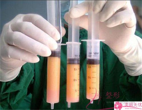 線雕提升術(shù)去除鼻唇溝皺紋貴嗎？多少元