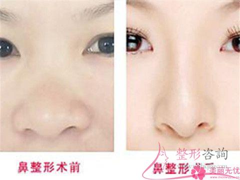 <a href=http://www.sbs17.com/listinfo-754-0.html target=_blank class=infotextkey>鼻翼</a>縮小術(shù)大概會(huì)發(fā)生哪些風(fēng)險(xiǎn)