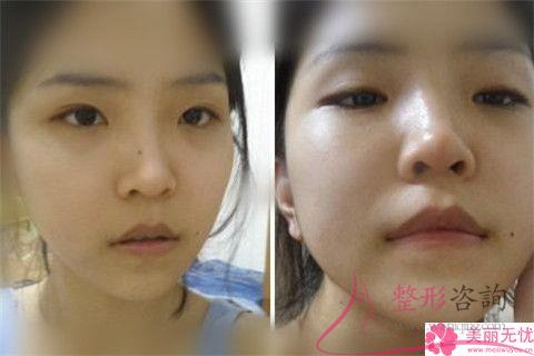 <a href=http://www.sbs17.com/listinfo-754-0.html target=_blank class=infotextkey>鼻翼</a>美容整形術(shù)方式都有哪幾種
