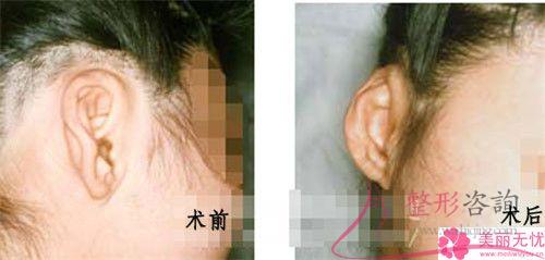 傷口沾水后不利于自體脂肪<a href=http://www.sbs17.com/listinfo-694-0.html target=_blank class=infotextkey>豐耳垂</a>后的恢復(fù)嗎