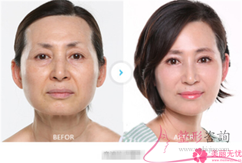 <a href=http://www.sbs17.com/listinfo-611-0.html target=_blank class=infotextkey>超聲刀</a>提升痛不痛啊