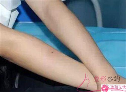 去除唇毛運(yùn)用冰點(diǎn)<a href=http://www.sbs17.com/listinfo-670-0.html target=_blank class=infotextkey>脫毛</a>有危險(xiǎn)嗎