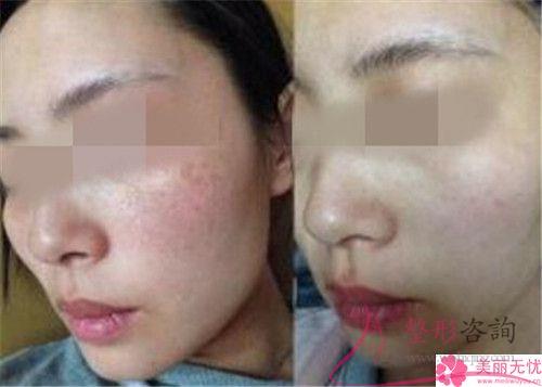 彩光去除黃褐斑和<a href=http://www.sbs17.com/listinfo-790-0.html target=_blank class=infotextkey>水光針</a>一同實(shí)施多少錢