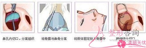 注射微晶瓷<a href=http://www.sbs17.com/listinfo-737-0.html target=_blank class=infotextkey>隆鼻</a>的常見注意事項具體有哪些